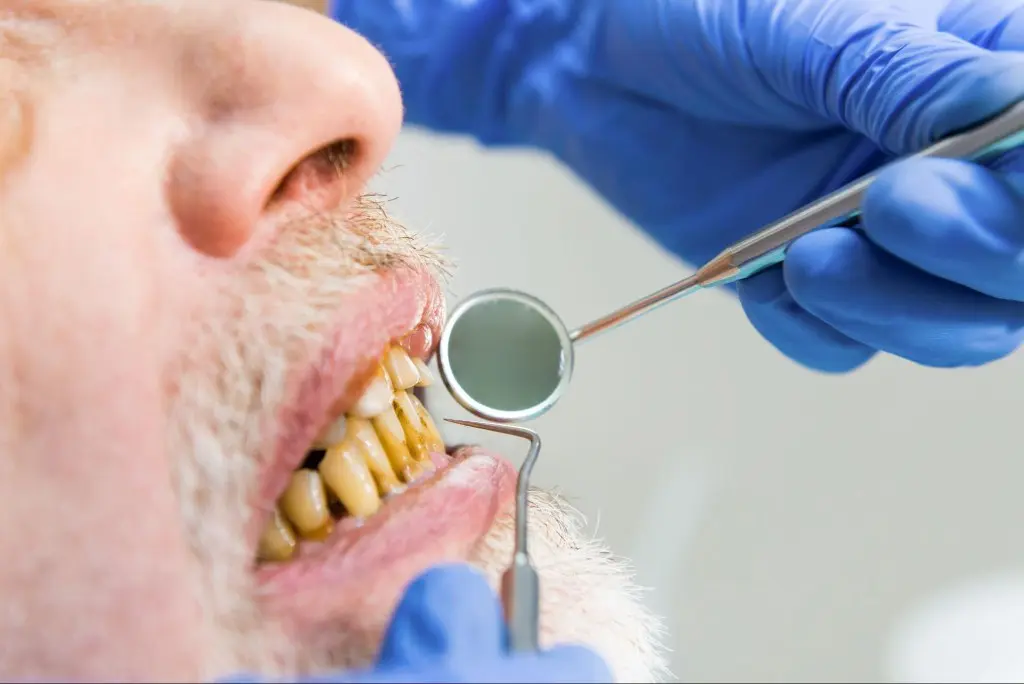 6 foods that stain teeth
