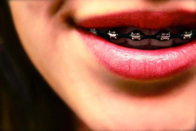 ¿Qué se debe conocer antes de tener frenos dentales (Brackets)?