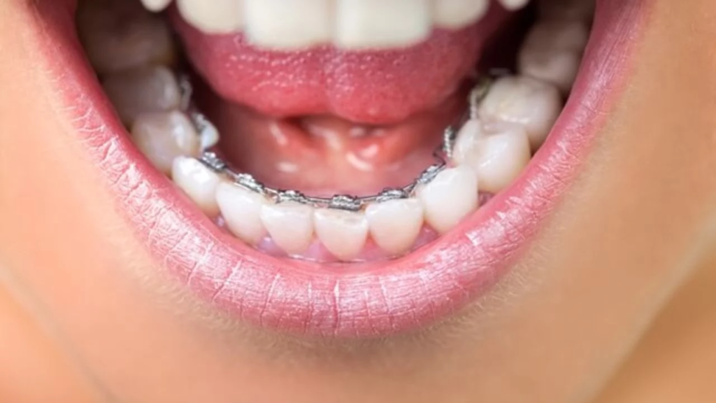 lingual braces behind teeth