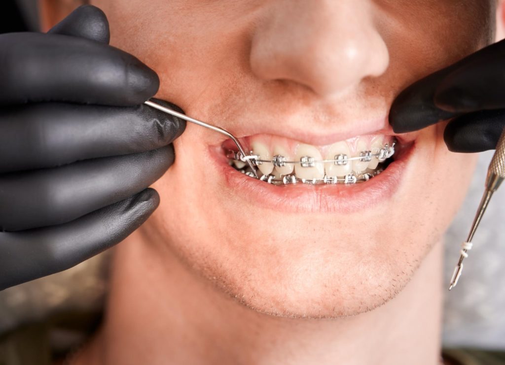 orthodontist placing rubber bands male patient braces explaining the different methods of orthodontic treatments