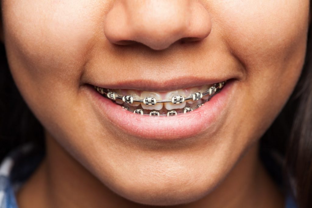smile woman with metal traditional braces