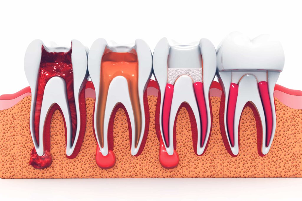 Root Canal Treatment in Phoenix