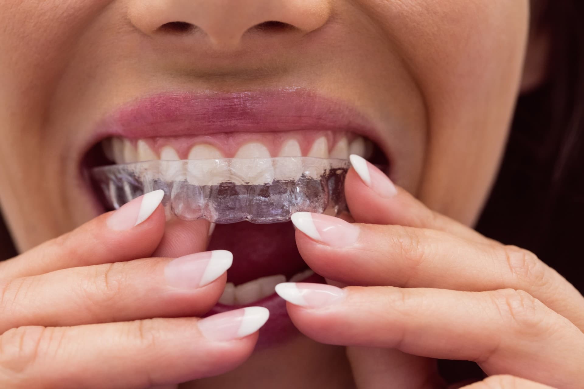 Invisalign Cost in Palos Verdes and South Bay, California