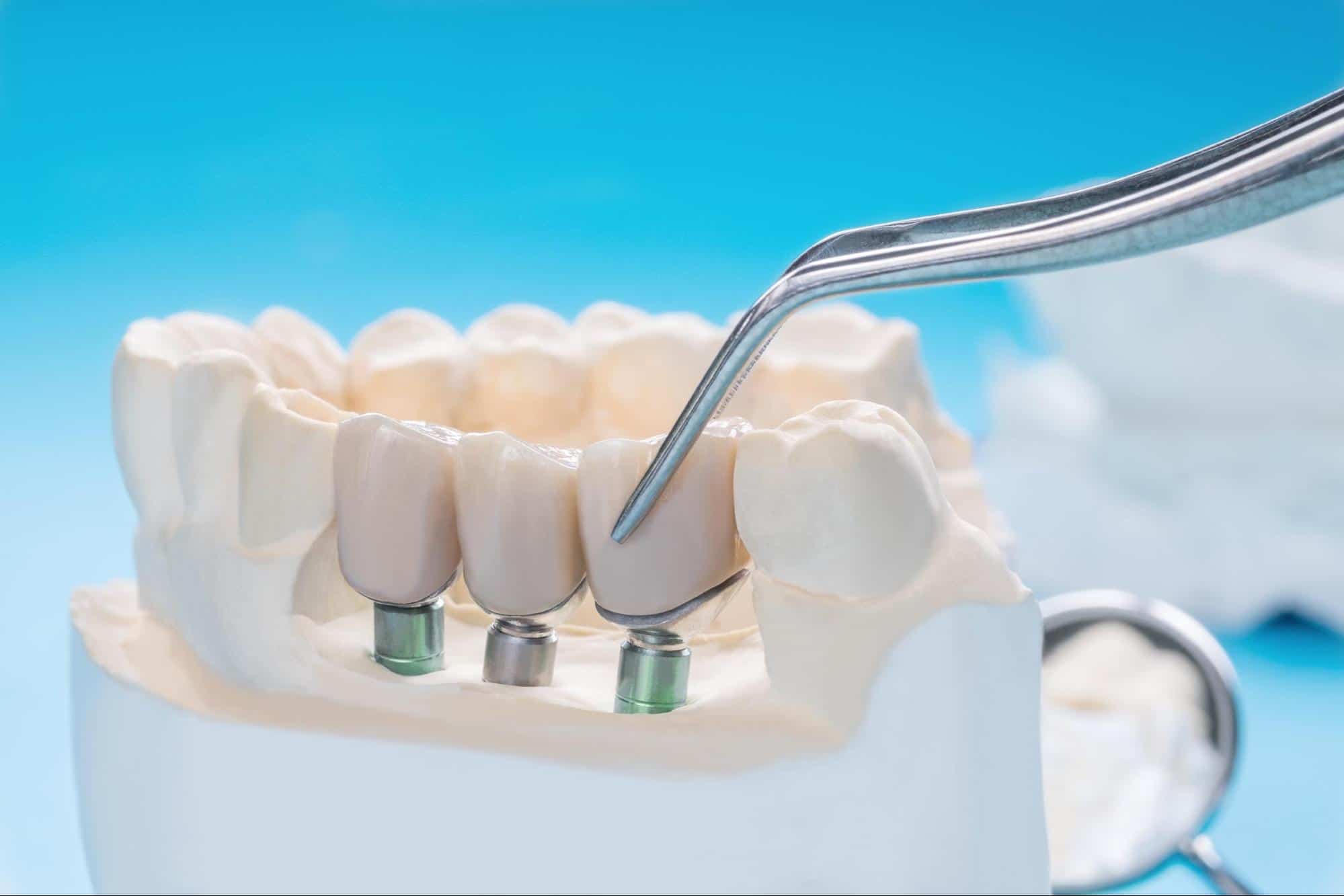 Cómo se pone un diente postizo provisional? - Clínica Dental en