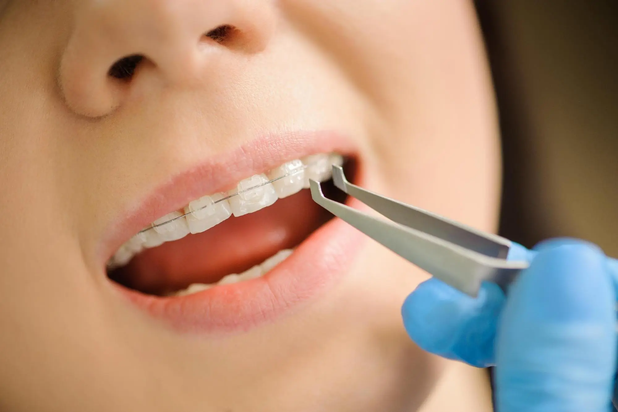 Advantages and disadvantages of ceramic braces