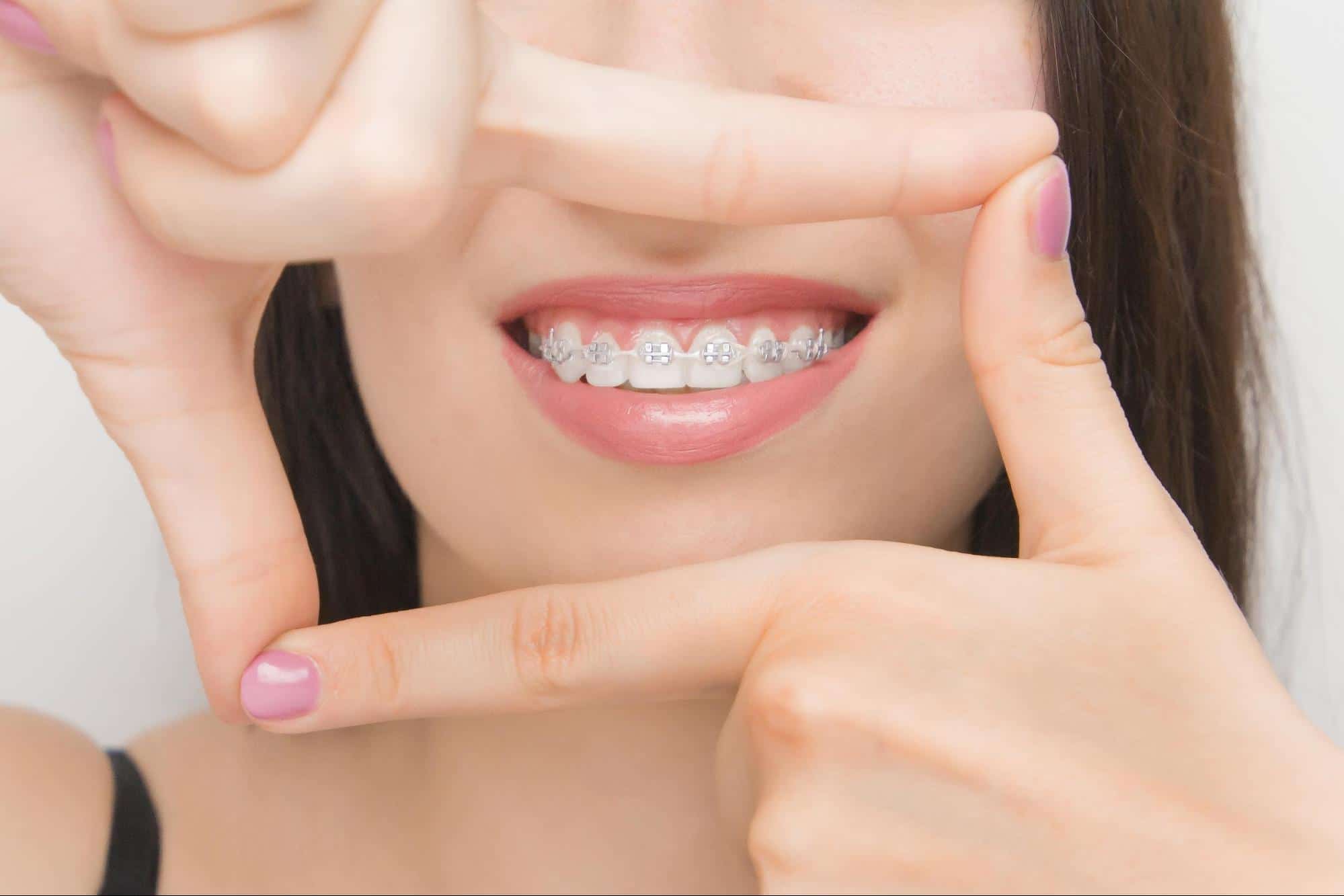 Advantages and disadvantages of ceramic braces Somos Dental
