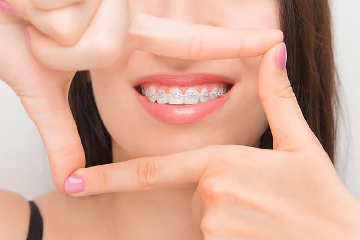 How-to-take-care-of-braces-01