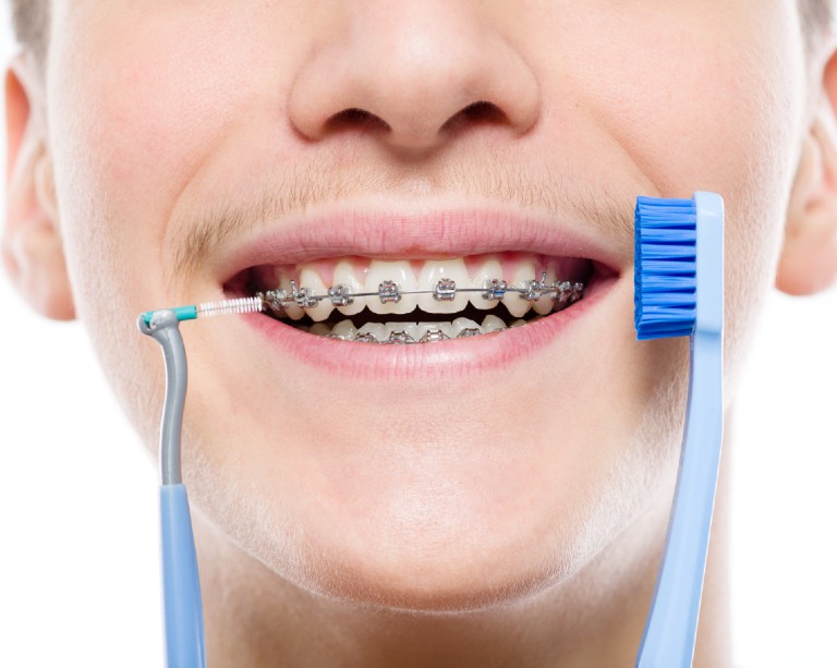 Tips for Brushing Your Teeth with Braces Somos Dental