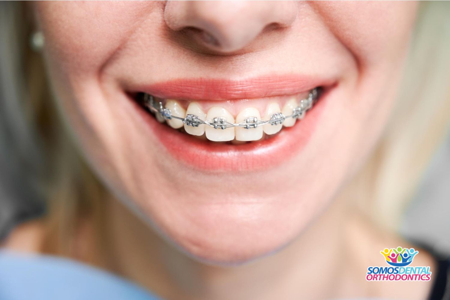 Are Braces The Miracle Solution for an Asymmetrical Face?