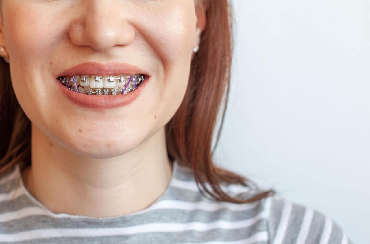 How do elastic rubber bands for braces work? – Somos Dental