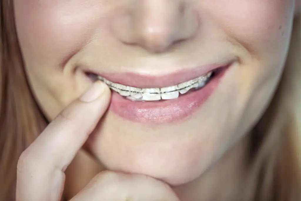 Ceramic Braces