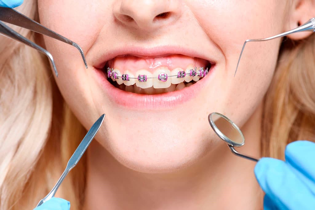 How long do braces treatments last? Somos Dental