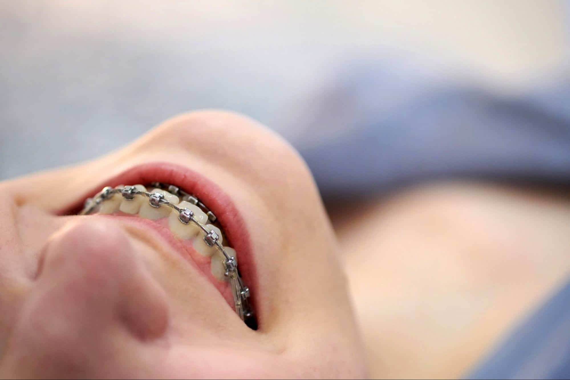 Cómo se aprietan los brackets? – Somos Dental