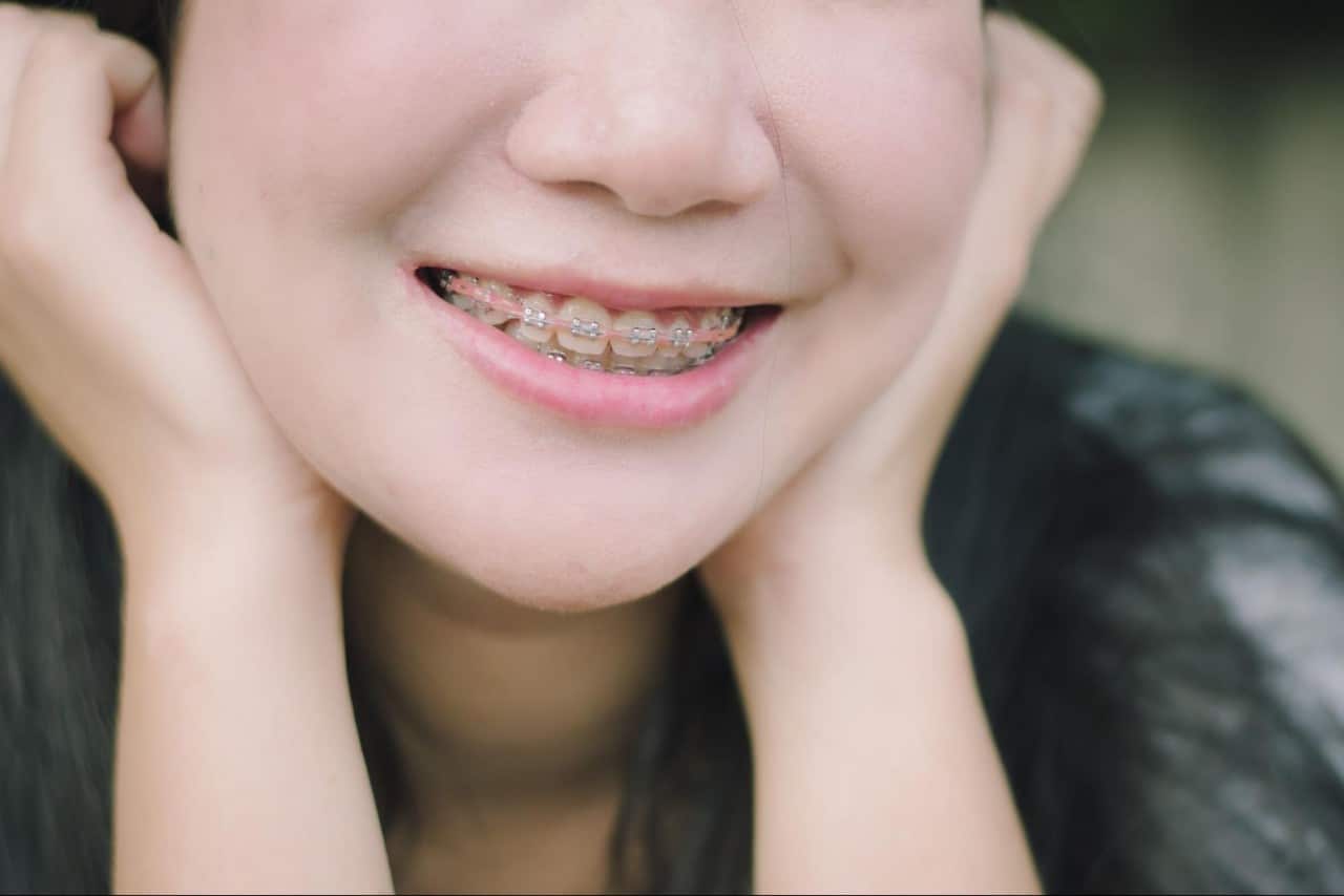 Get to know the different types of braces available