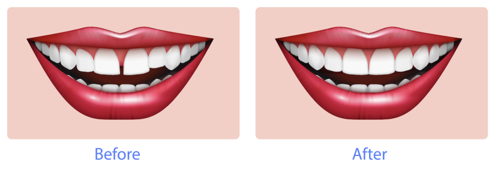 illustration of moth and teeth showing the differences between ceramic braces before and after
