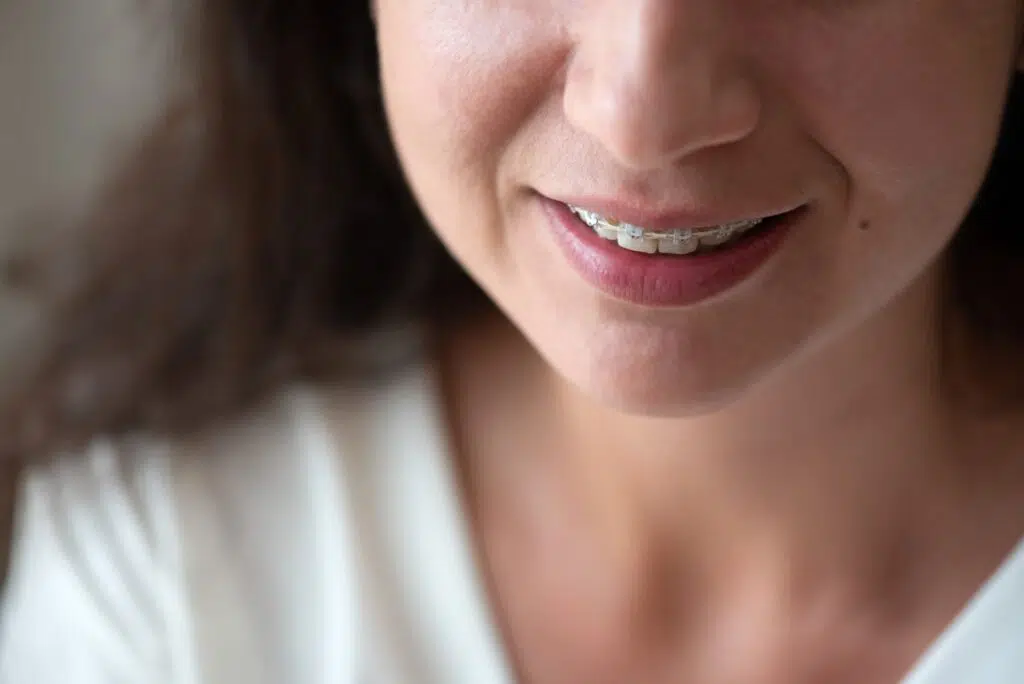 __ceramic braces before and after
