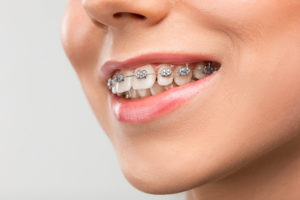 What are braces made of?