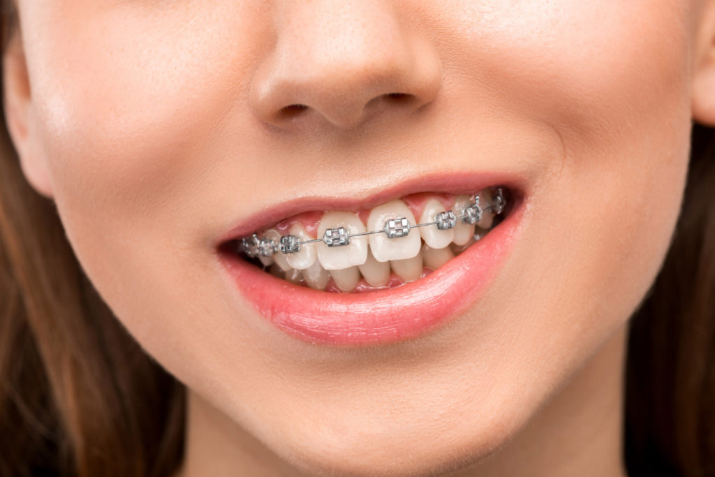beautiful young woman with crooked teeth with braces