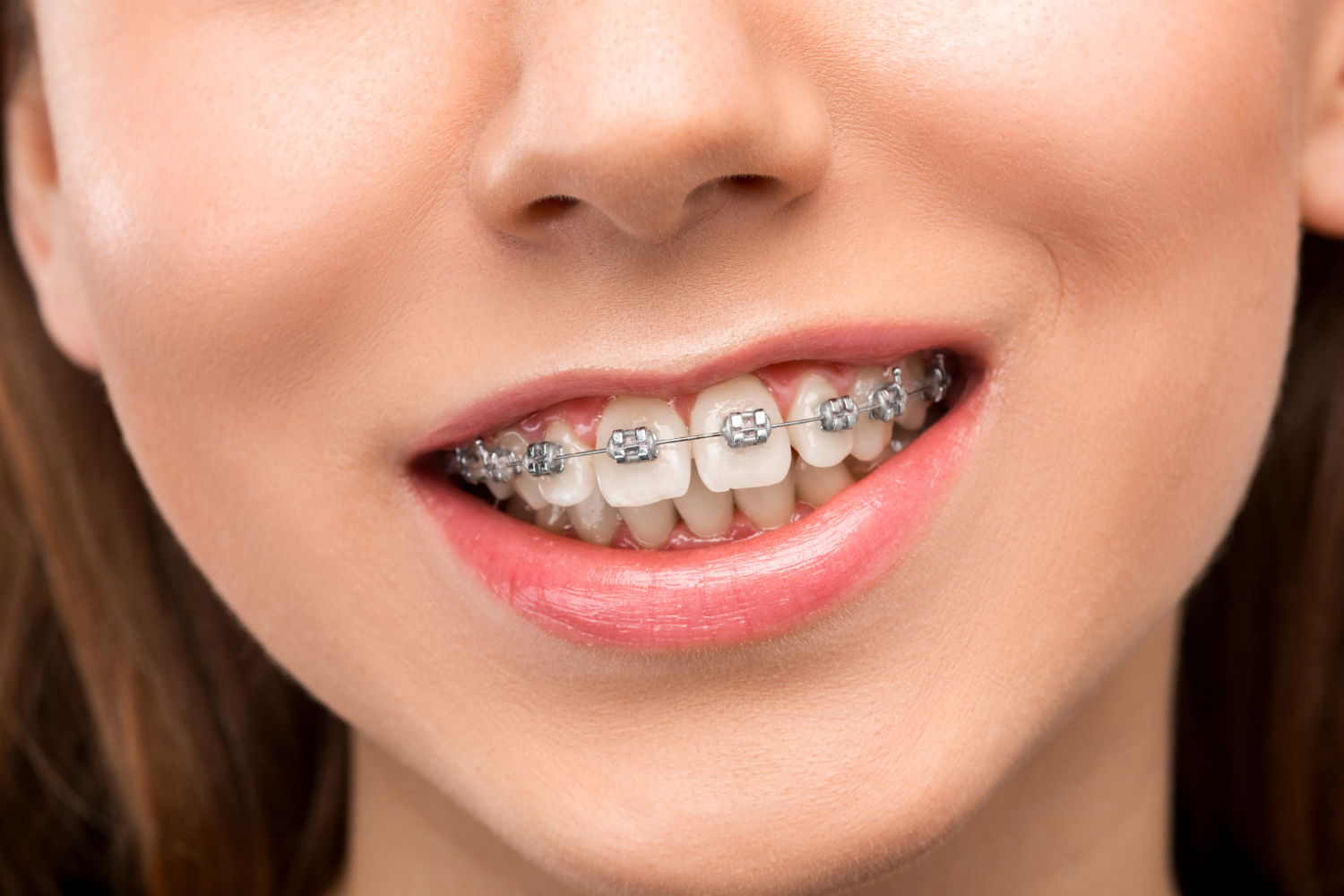 ¿Cómo funcionan los brackets en dientes apiñados?