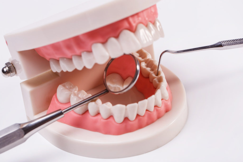 white teeth model to explain how long does it take to remove 4 wisdom teeth