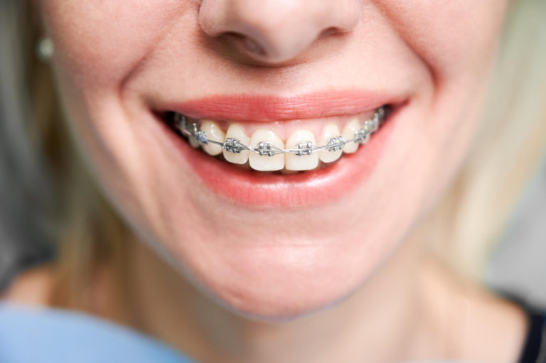 young woman smiling and showing what are braces made out of