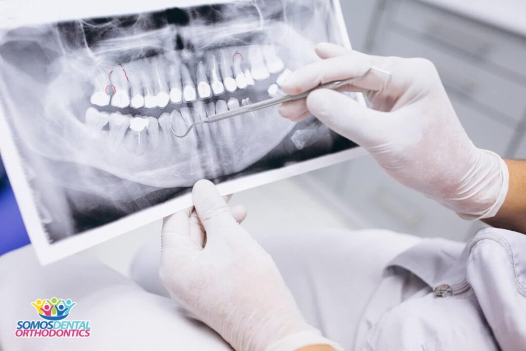rayos x de dientes para calcular cuanti tiempo llevaria extraer las muelas del juicio