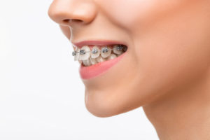 Best age to get braces for an overbite