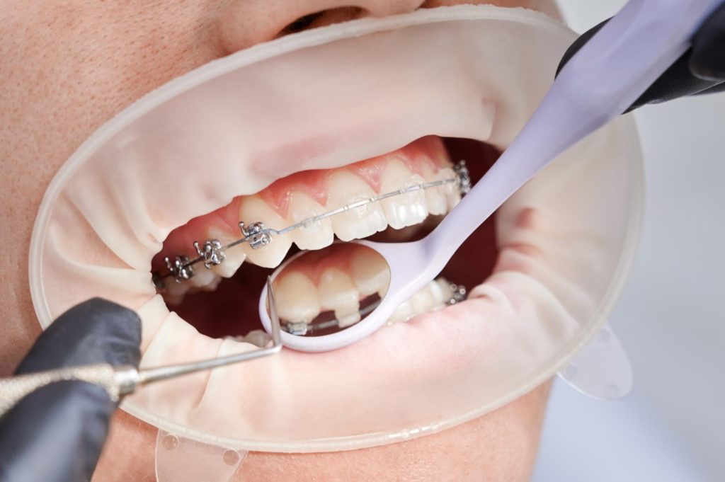 dentist attaching metal braces to patient teeth explaining if do braces hurt the first day