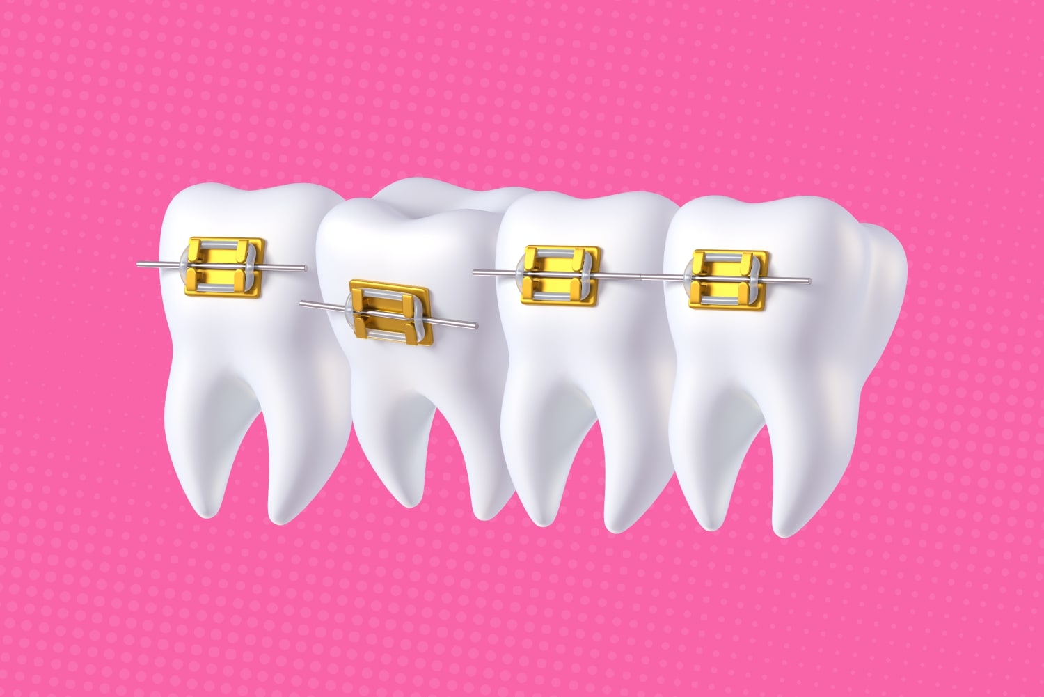 ckets para explicar si los brackets pueden hacer que tus dientes se caigan