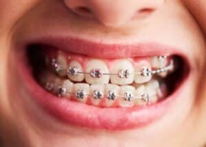 child teeth with elastic for braces