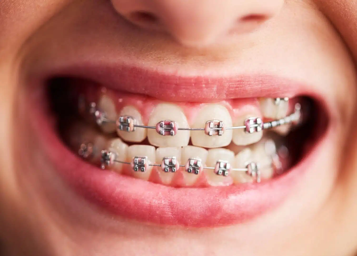 ¿Para qué sirven las ligas en los brackets?