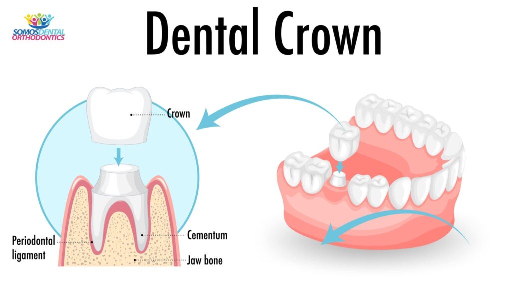 Infographic of teeth in dental crown-min