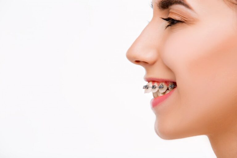 beautiful young woman with teeth braces learning if do braces fix overbite