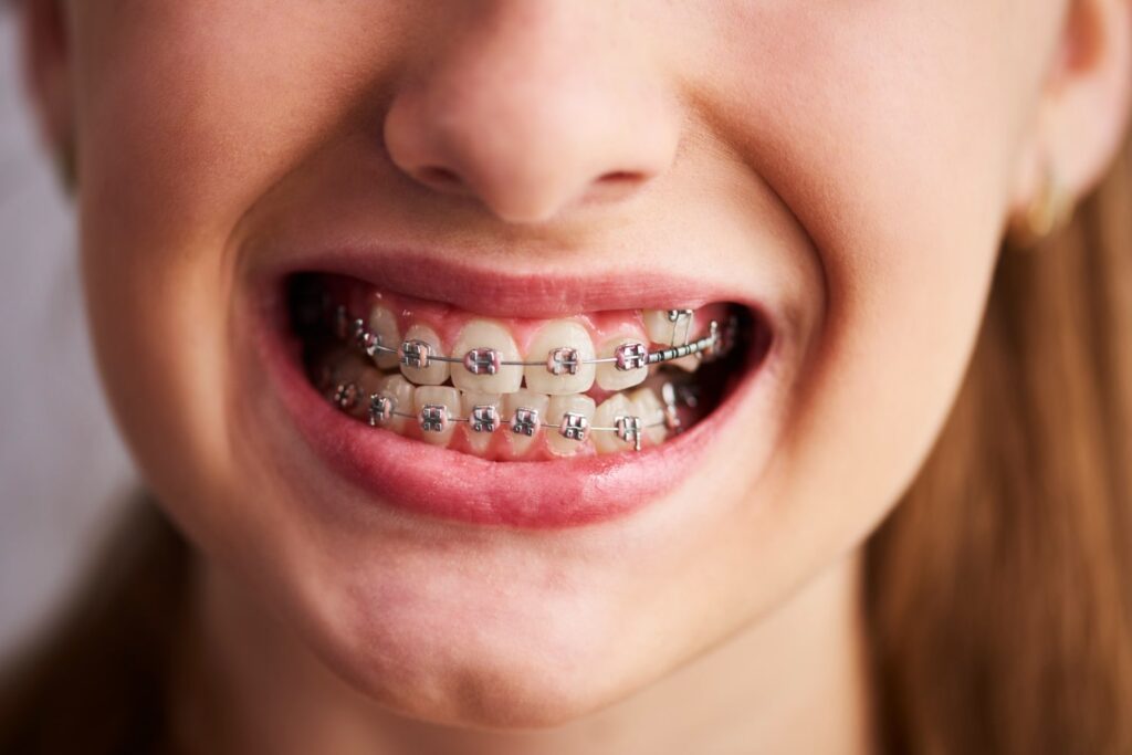 Female teenager showing his metal orthodontic to explain whats cheaper braces or Invisalign