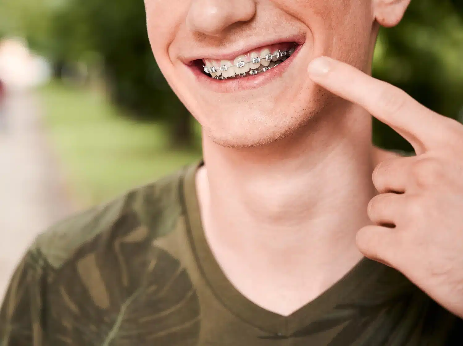 When Do Braces Start Working? All You Need to Know