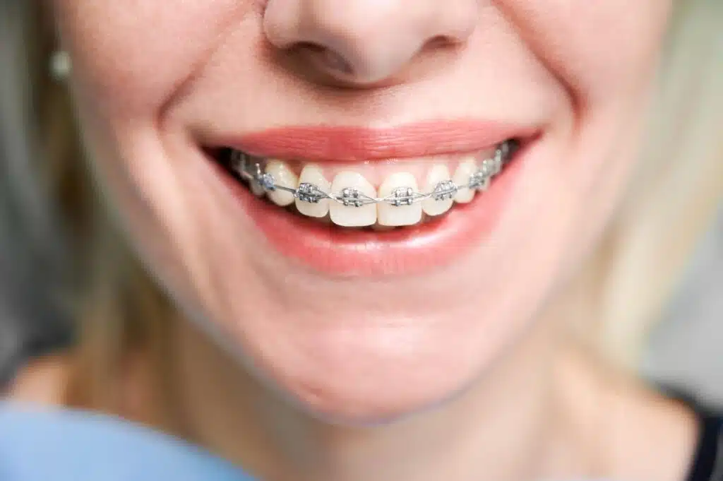 Young woman smiling with orthodontic to explain how long does it take for braces to start working