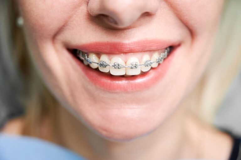 Young woman smiling with orthodontic to explain how long does it take for braces to start working
