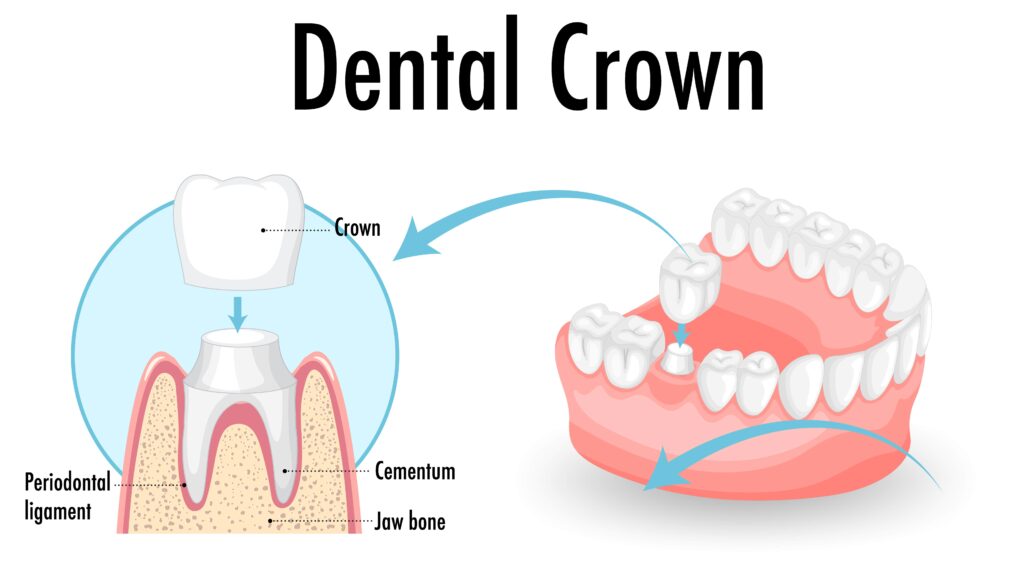 Infographic to explain what is a crown for your teeth