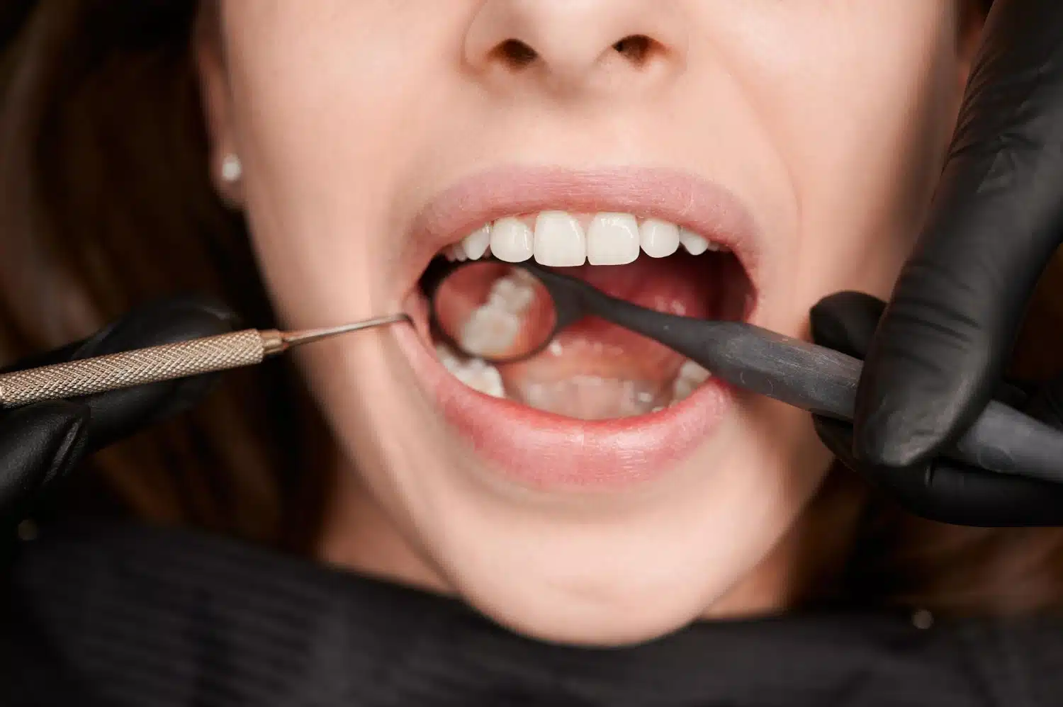 ¿Puedo Ponerme Brackets Si Tengo Caries?