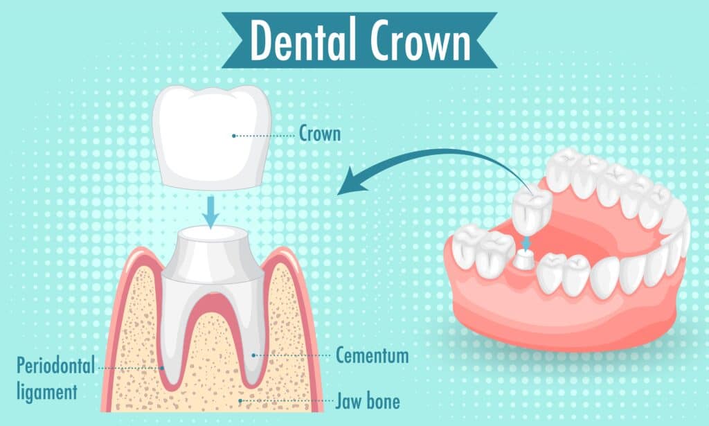 graphic with illustration of a teeth to explain what is and how it works a dental crown