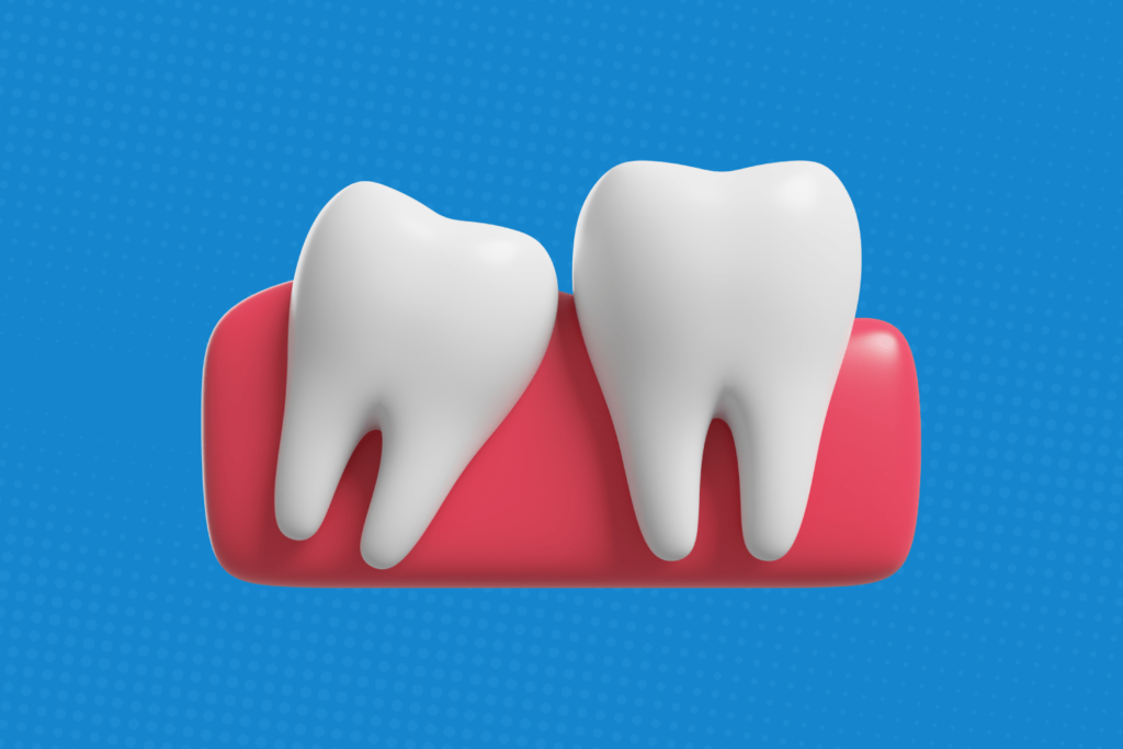 3d illustraton of whisdom teeth to promote affordable wisdom teeth removal in dallas texas