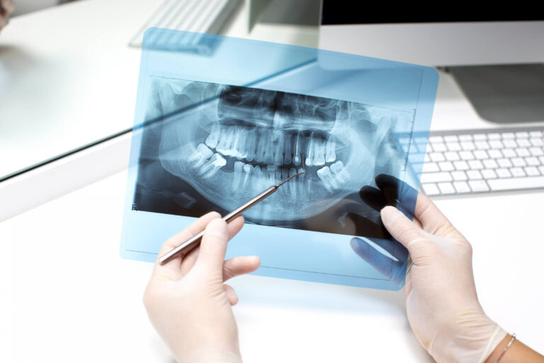 X-ray of teeth to explain if will everyone get wisdom teeth removed